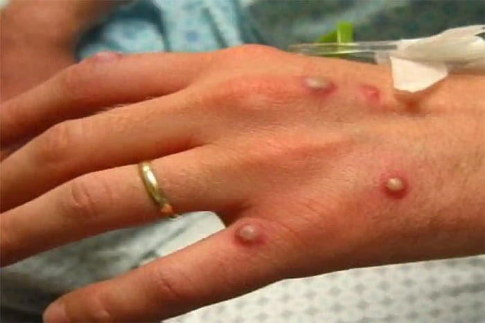 monkey pox 4 मंकी पाक्‍स की संदिग्‍ध महिला मरीज मिली पटना में, बिहार में एहतियाती गाइडलाइन जारी