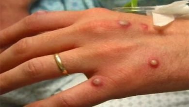 monkey pox 2 दिल्ली: मंकीपॉक्स का 5वां मरीज मिला, 22 साल की महिला एलएनजेपी अस्पताल में भर्ती
