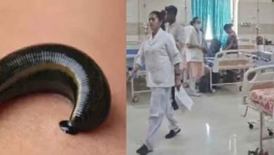 chhattisgarh 05 1 4 छत्तीसगढ़-कोरबा में चार साल की बच्ची के गुप्तांग में घुसी जोंक, डॉक्टरों ने सूझबूझ से निकाली बाहर