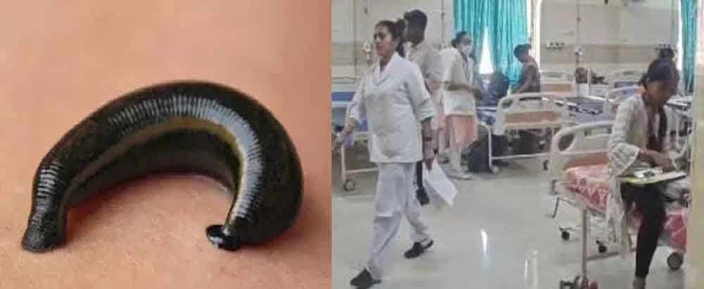 छत्तीसगढ़-कोरबा में चार साल की बच्ची के गुप्तांग में घुसी जोंक, डॉक्टरों ने सूझबूझ से निकाली बाहर 1 chhattisgarh 05 1 4 छत्तीसगढ़-कोरबा में चार साल की बच्ची के गुप्तांग में घुसी जोंक, डॉक्टरों ने सूझबूझ से निकाली बाहर