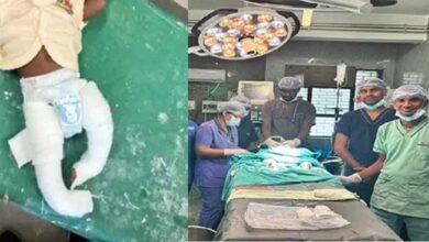 chhattisgarh 11 1 19 छत्तीसगढ़-बिलासपुर में सिम्स अस्पताल के डाक्टरों का कमाल, टेढ़े पैर वाले तीन सौ बच्चों का सफल ऑपरेशन
