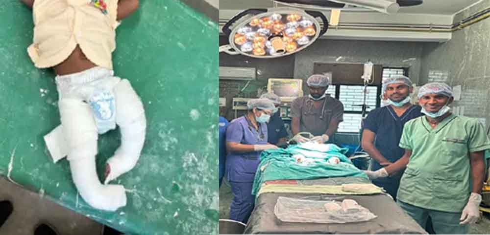 छत्तीसगढ़-बिलासपुर में सिम्स अस्पताल के डाक्टरों का कमाल, टेढ़े पैर वाले तीन सौ बच्चों का सफल ऑपरेशन 1 chhattisgarh 11 1 19 छत्तीसगढ़-बिलासपुर में सिम्स अस्पताल के डाक्टरों का कमाल, टेढ़े पैर वाले तीन सौ बच्चों का सफल ऑपरेशन
