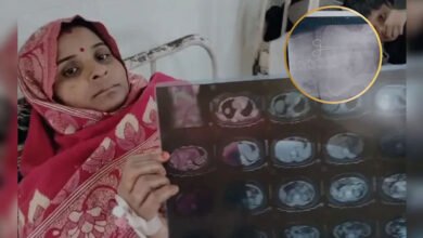 30A 58 भिंड में डॉक्टरों की लापरवाही का बेहद ही चौंकाने वाला मामला सामने आया, एक महिला के पेट के अंदर से कैंची निकली