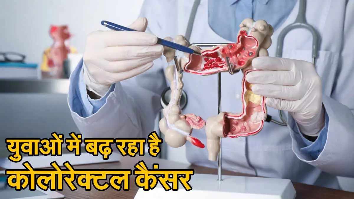 Colorectal Cancer: युवाओं में बढ़ रहा है कोलोरेक्टल कैंसर 1 Colorectal Cancer