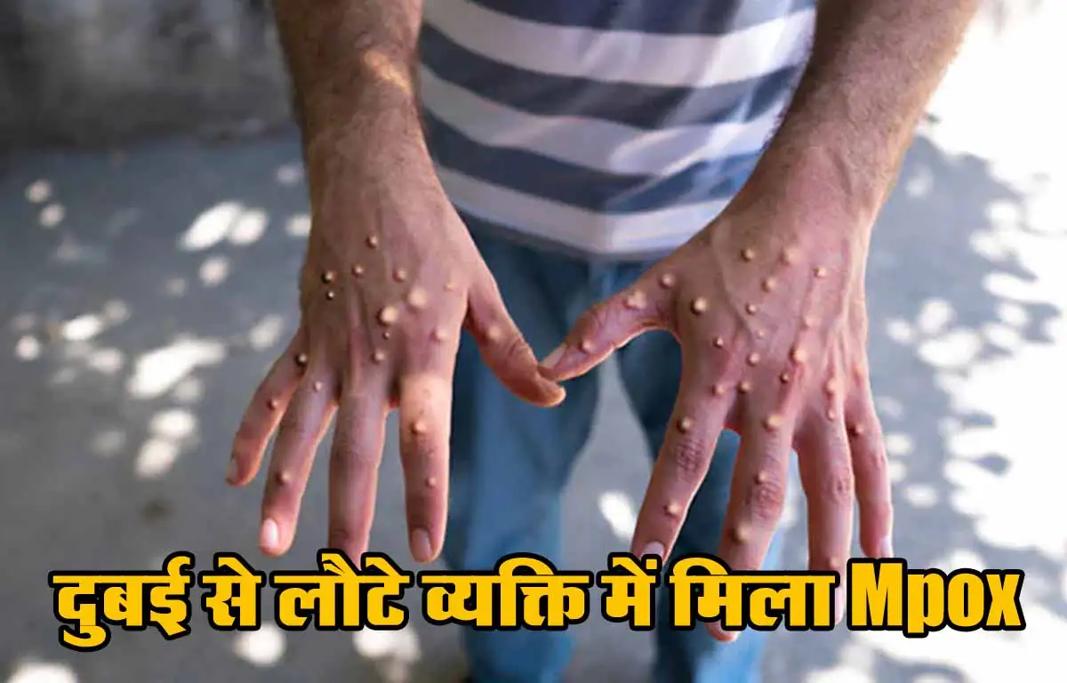 Monkey Pox New Case: हो जाएं सावधान, दुबई से लौटे व्यक्ति में मिला Mpox, जानिए लक्षण और बचाव के तरीके 1 Monkey Pox New Case