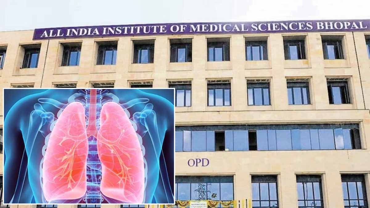 Bhopal News: एम्स भोपाल में हुई शोध में टीबी की छिपी हुई बीमारी का पता चला है, लक्षण नहीं दिखने पर भी बीमारी हो सकती है 1 Bhopal News